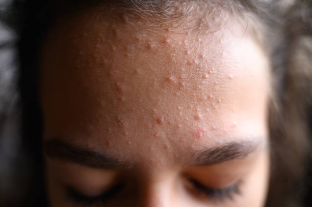 propolis akne